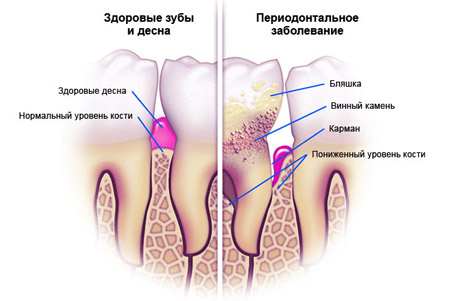 Лечение пародонтоза в СПб