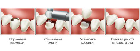 коронка на зуб